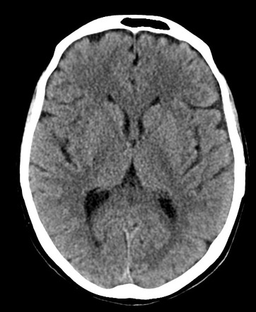 Hemangioblastoma | Radiology Case | Radiopaedia.org