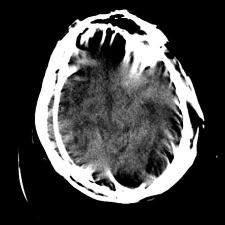 Motion artifact | Radiology Reference Article | Radiopaedia.org