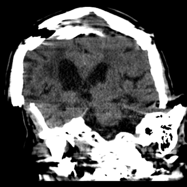 CT brain with severe motion artifact | Image | Radiopaedia.org