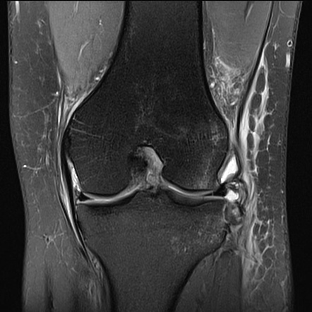 Anterior cruciate ligament rupture with Segond fracture | Radiology ...