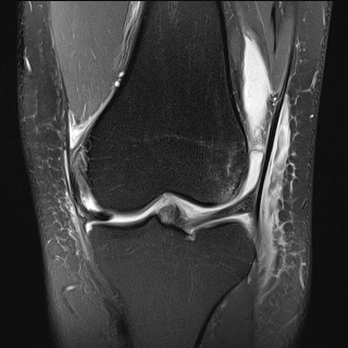 Anterior cruciate ligament rupture with Segond fracture | Image ...