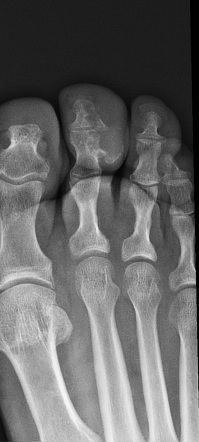 Chondrosarcoma - Phalanx | Radiology Case | Radiopaedia.org