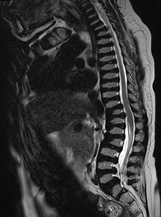 Morquio syndrome | Radiology Reference Article | Radiopaedia.org