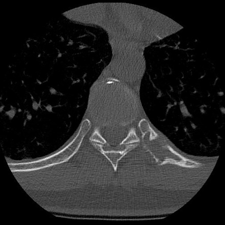 Rib fibrous dysplasia | Radiology Case | Radiopaedia.org