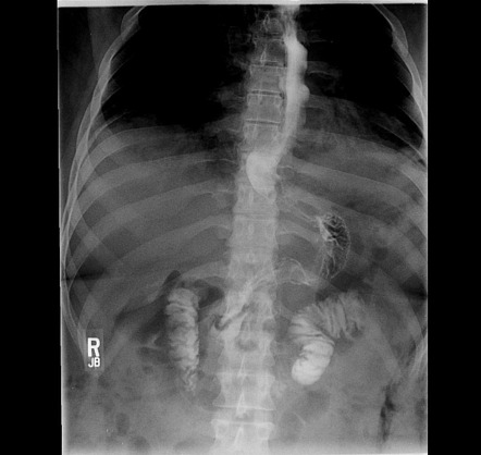 Sleeve gastrectomy | Radiology Reference Article | Radiopaedia.org