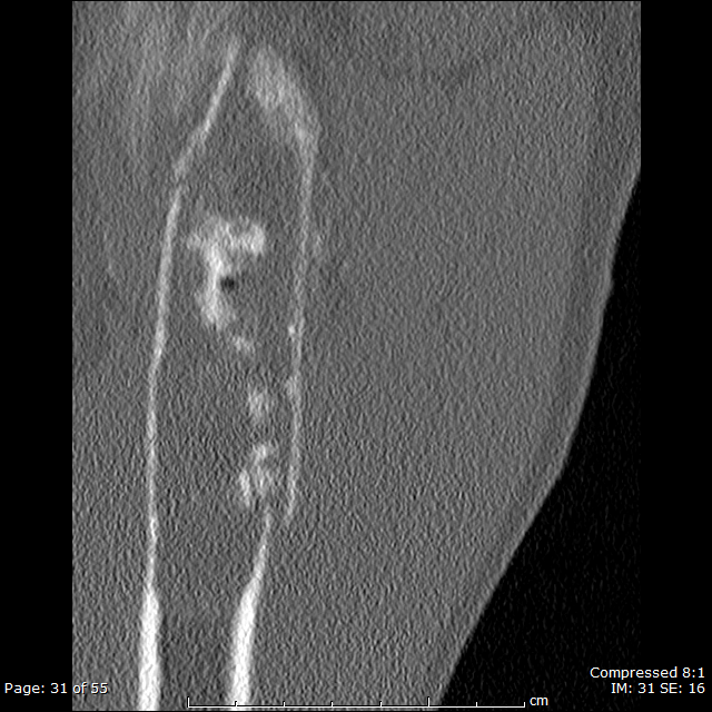 Simple Bone Cyst With Pathologic Fracture Image