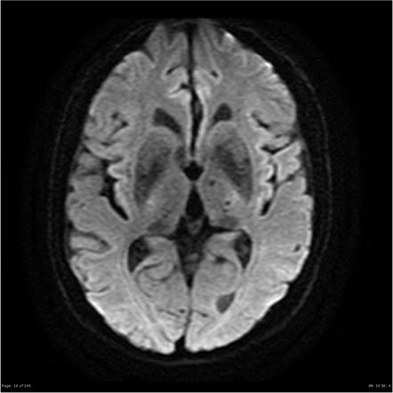 Cerebral amyloid angiopathy presenting with psychiatric symptoms ...