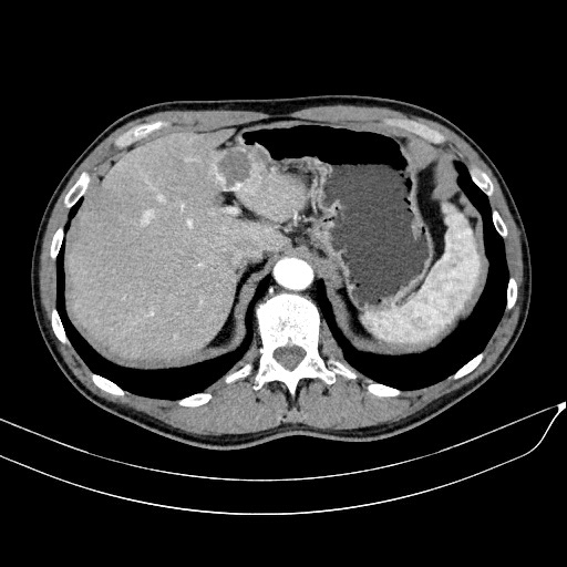 Hepatic hemangioma - contrast enhanced ultrasound | Image | Radiopaedia.org