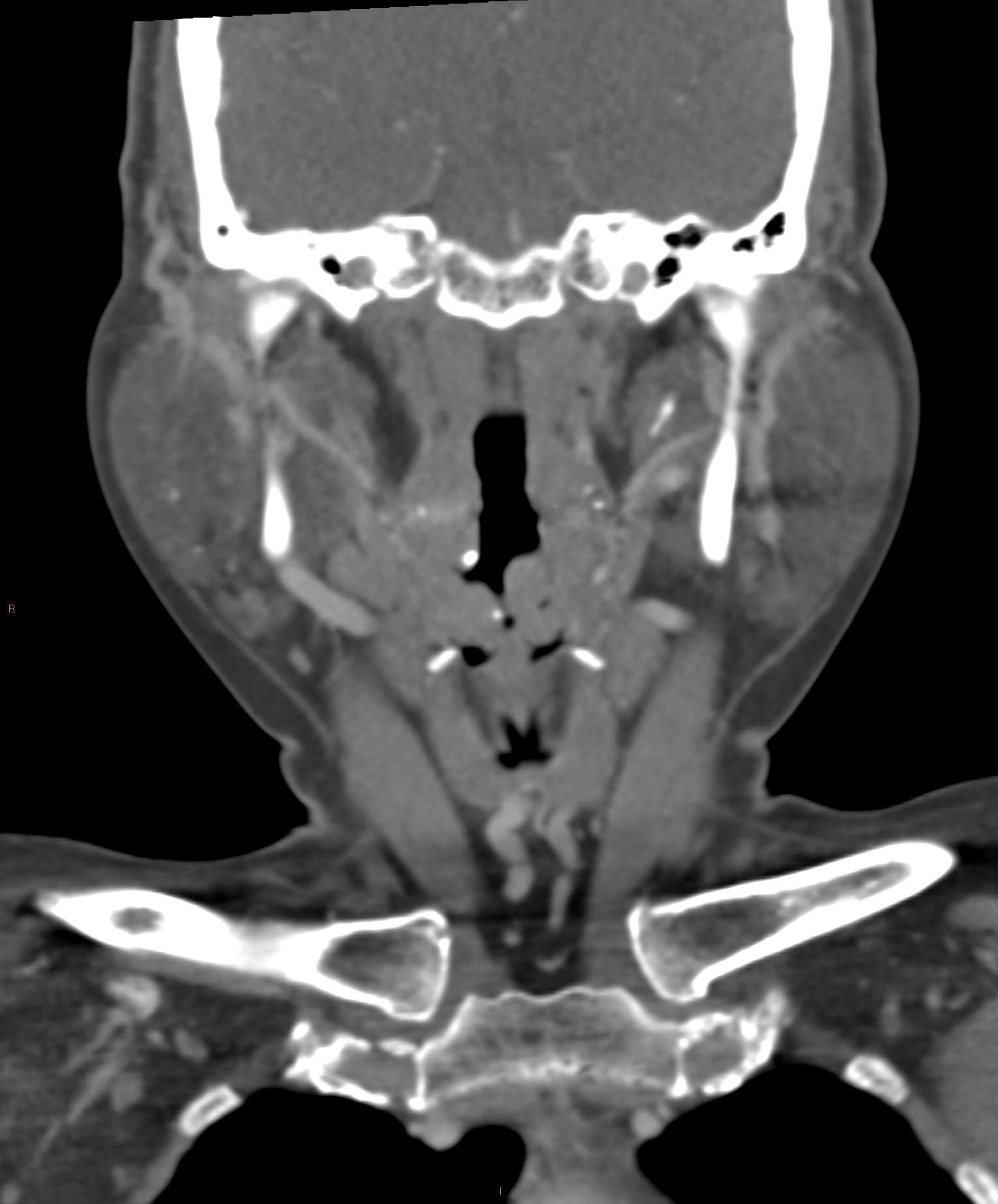 Normal CT neck Image