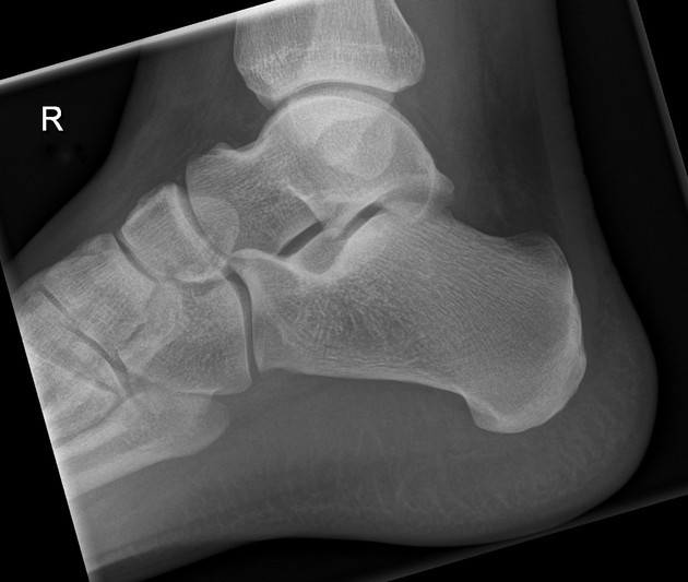 Böhler angle, Radiology Reference Article