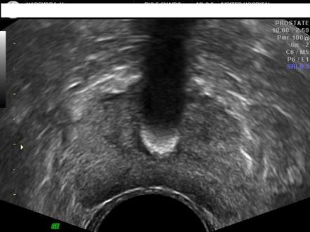 Urethral calculus | Radiology Reference Article | Radiopaedia.org