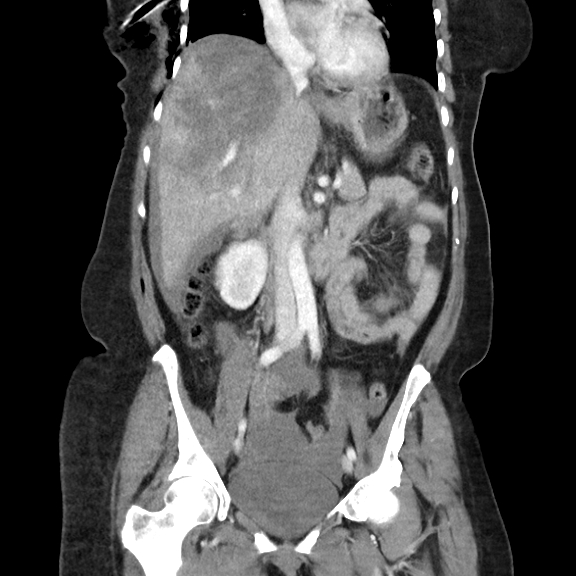 Post Traumatic Hepatic And Splenic Active Bleeding Image