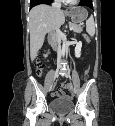 Duplicated inferior vena cava (type 2c) | Radiology Case | Radiopaedia.org