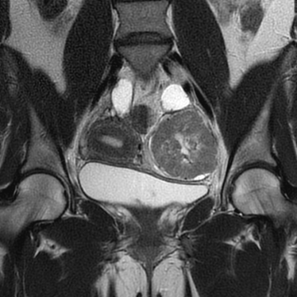 Ovarian fibrothecoma | Image | Radiopaedia.org