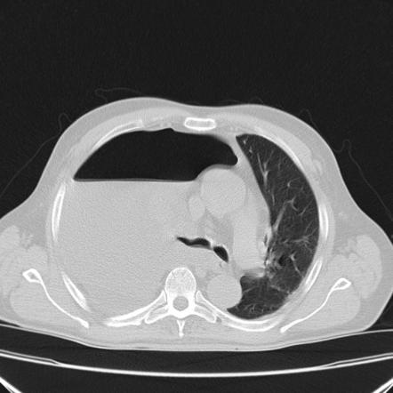 Hydropneumothorax | Radiology Reference Article | Radiopaedia.org