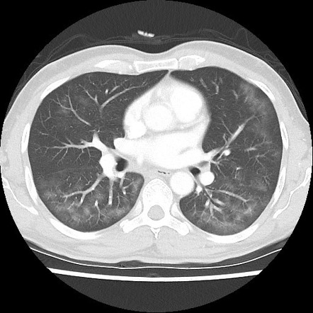 Pulmonary Pneumocystis jirovecii infection | Radiology Reference ...