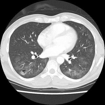 Pneumocystis jirovecii pneumonia | Radiology Case | Radiopaedia.org