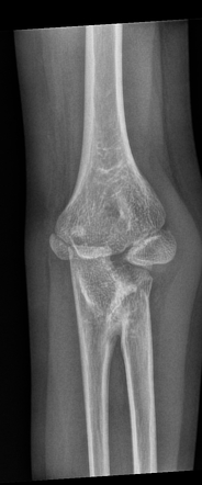 Proximal Radioulnar Synostosis | Radiology Case | Radiopaedia.org