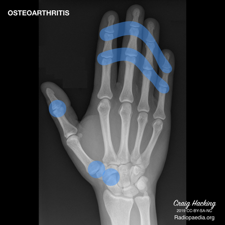 osteoarthritis hand xray