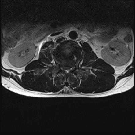 Burst fracture with cauda equina syndrome | Image | Radiopaedia.org