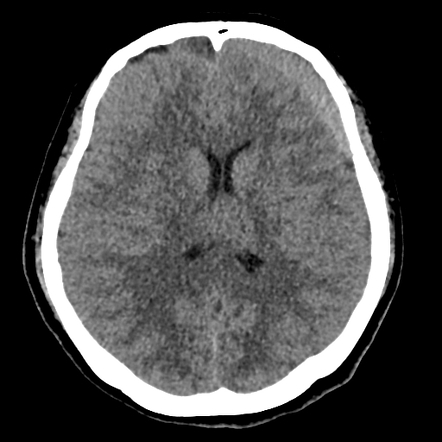 Bilateral subacute subdural hematoma | Image | Radiopaedia.org