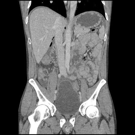 Perforated gastric ulcer | Image | Radiopaedia.org