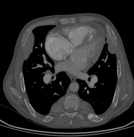 Extramedullary Hematopoiesis | Image | Radiopaedia.org