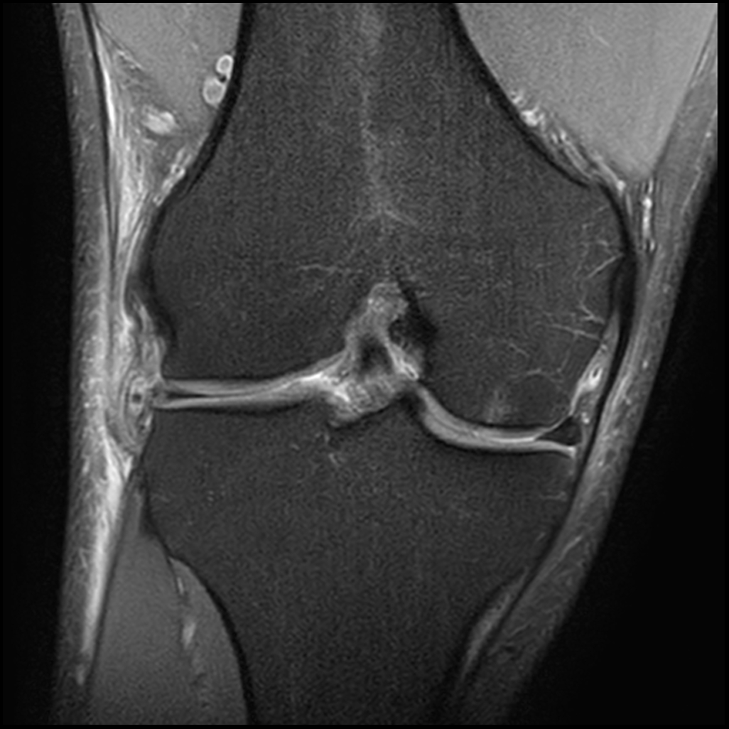 Subchondral insufficiency fracture post lateral meniscectomy | Image ...