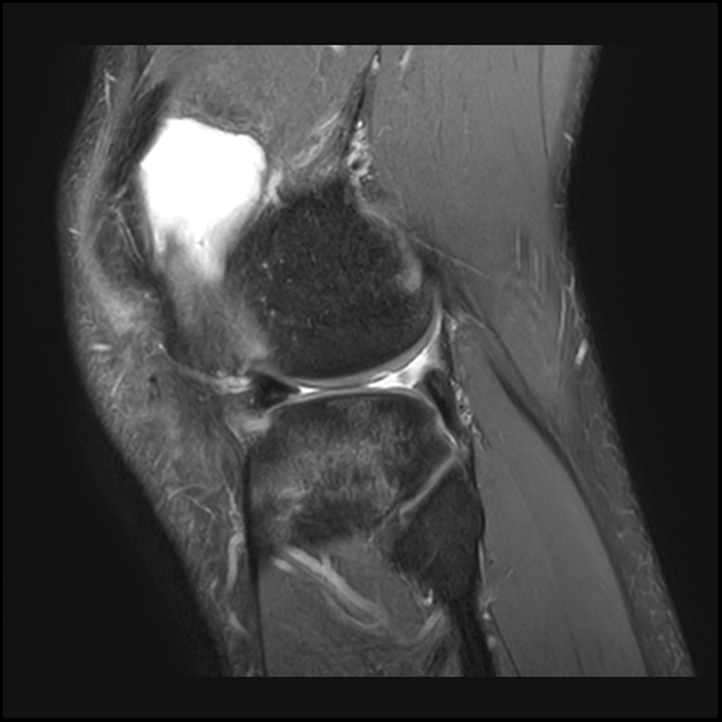 Subchondral Insufficiency Fracture Post Lateral Meniscectomy | Image ...