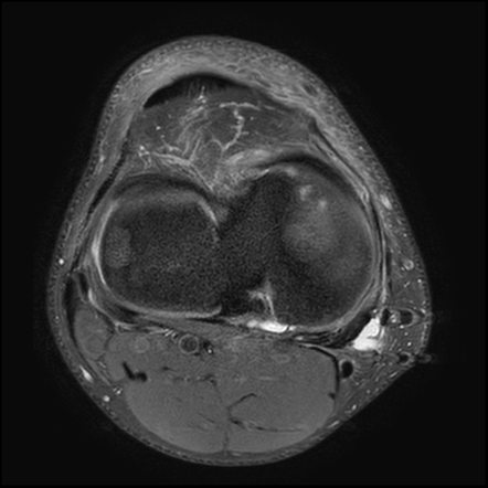 Subchondral insufficiency fracture post lateral meniscectomy | Image ...