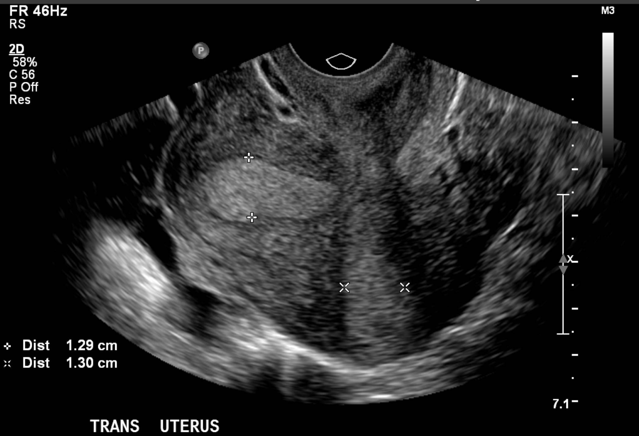 Radiology Quiz 69271 | Radiopaedia.org | Playlist 'UTERUS SHAPE 