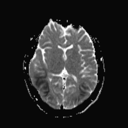 Status epilepticus | Image | Radiopaedia.org