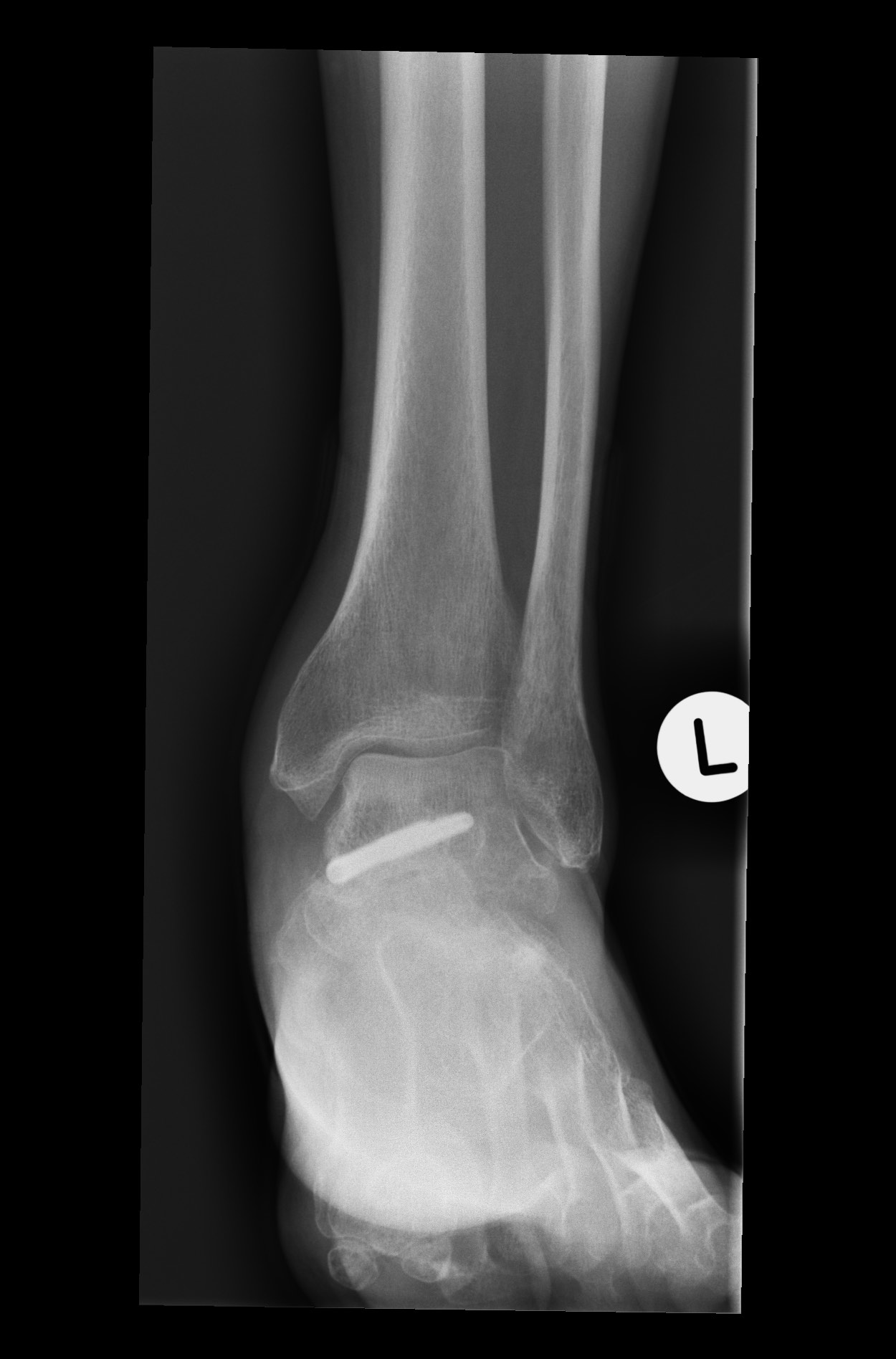 Talar neck fracture complicated by avascular necrosis | Image ...