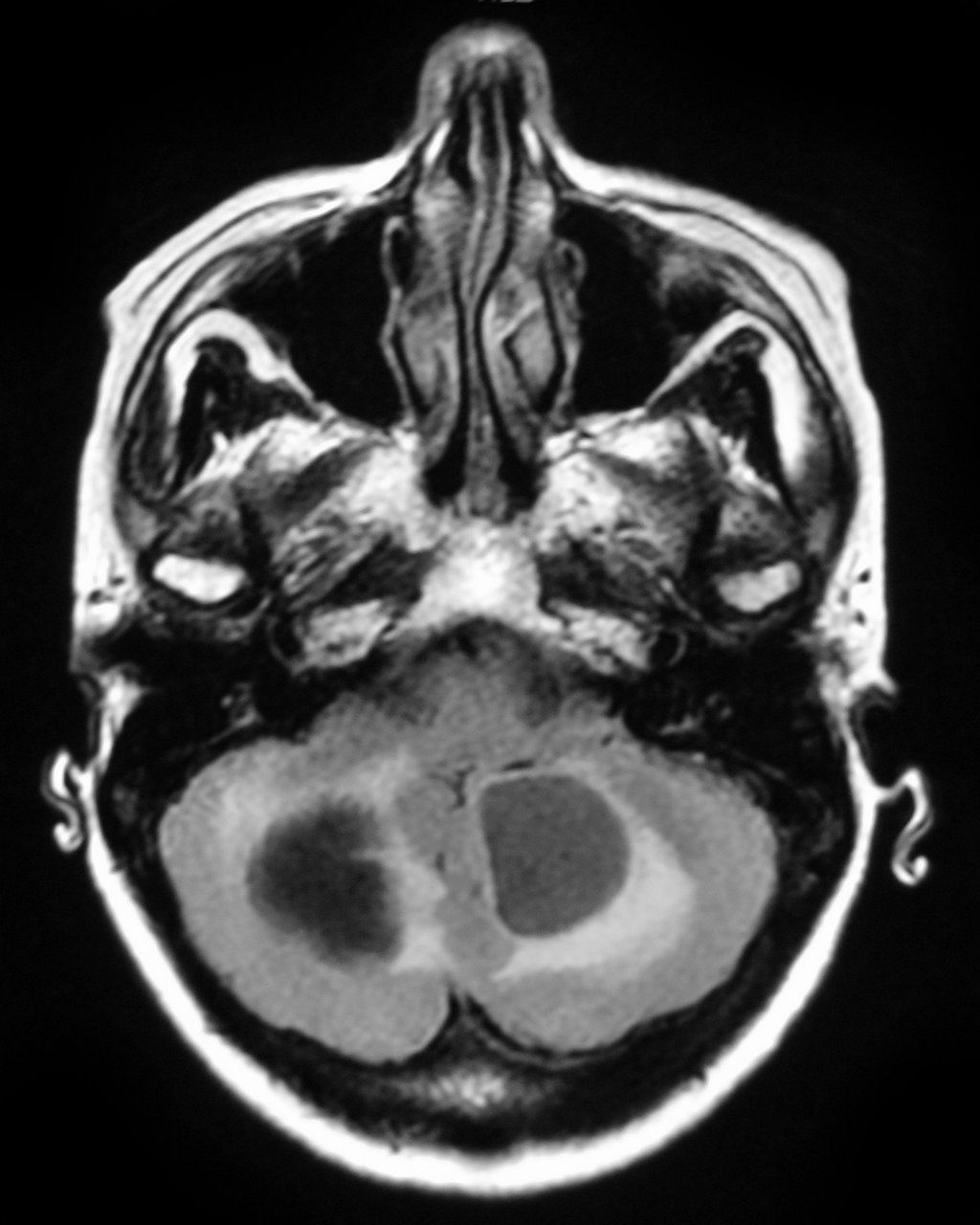 Cerebral metastases - small cell lung cancer | Image | Radiopaedia.org