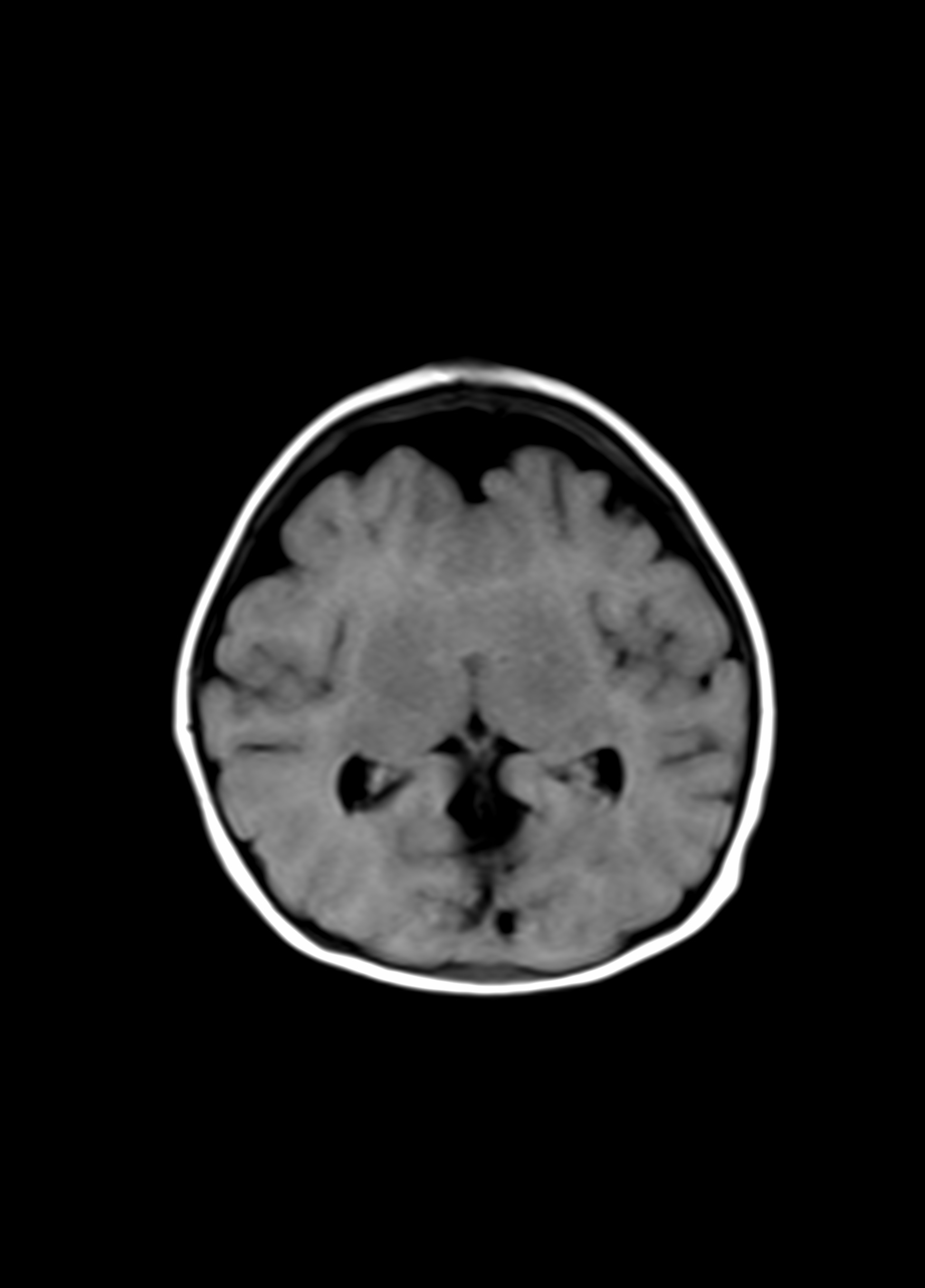 Fetal Holoprosencephaly