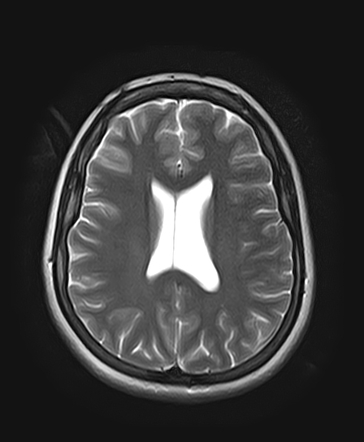 Asymmetry of the lateral ventricles | Radiology Case | Radiopaedia.org