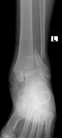 Ankle fracture - Weber C | Image | Radiopaedia.org