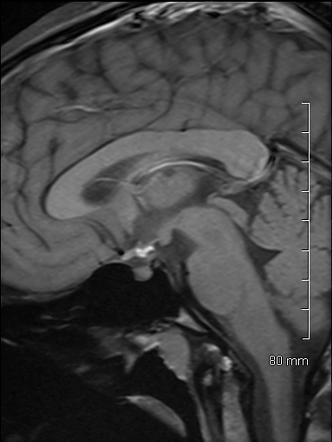 Ectopic posterior pituitary | Image | Radiopaedia.org