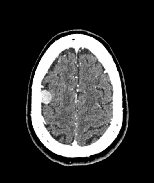 Meningioma | Radiology Reference Article | Radiopaedia.org