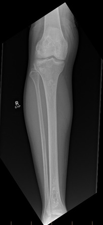 Femoral and tibial bone infarcts | Radiology Case | Radiopaedia.org