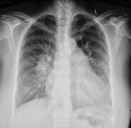 Atrial septal defect | Radiology Reference Article | Radiopaedia.org