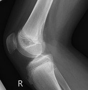 Osgood-Schlatter disease | Radiology Reference Article | Radiopaedia.org