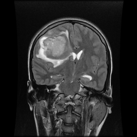 Hyperacute cerebral hematoma | Image | Radiopaedia.org