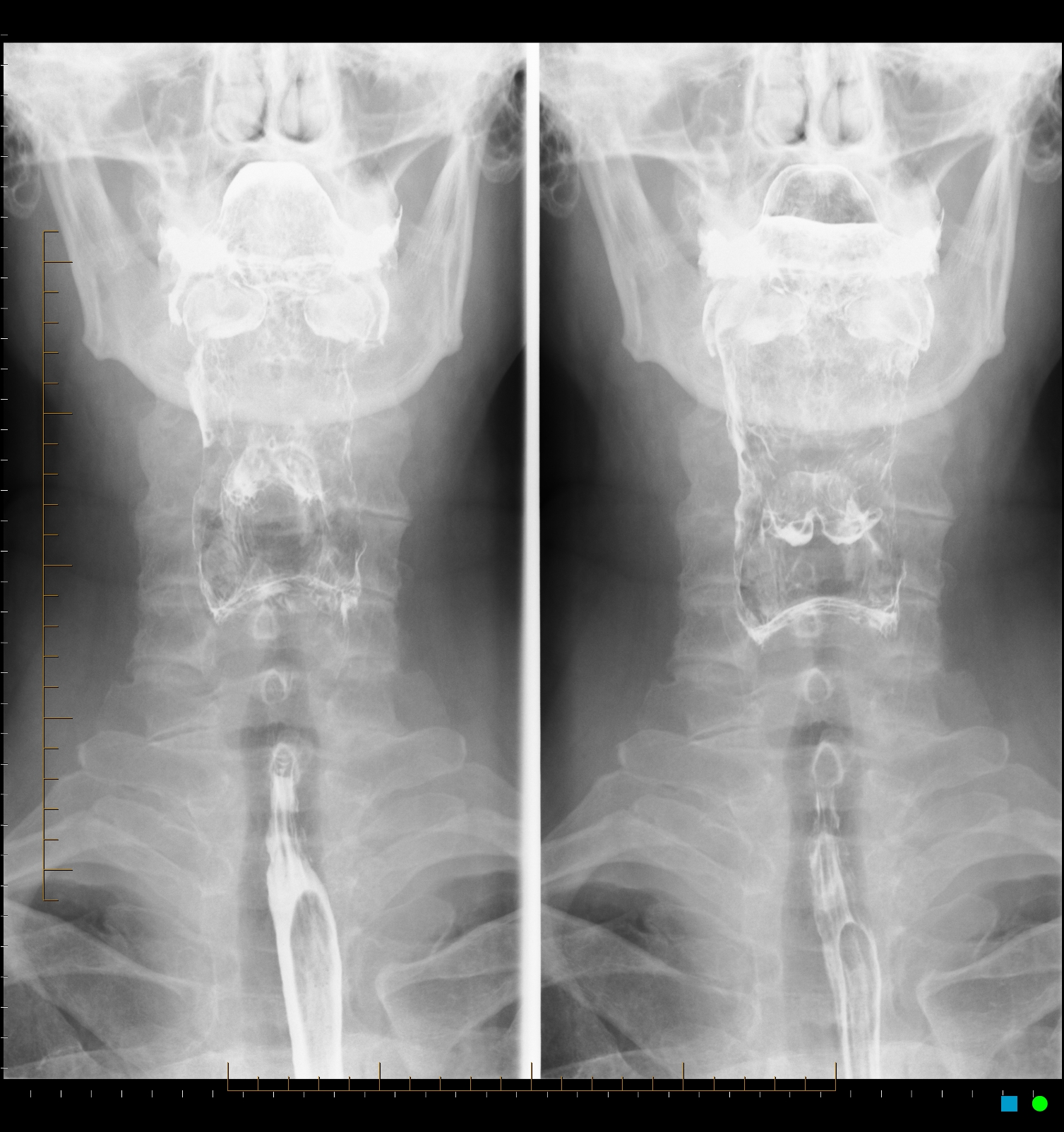 download barium swallow test