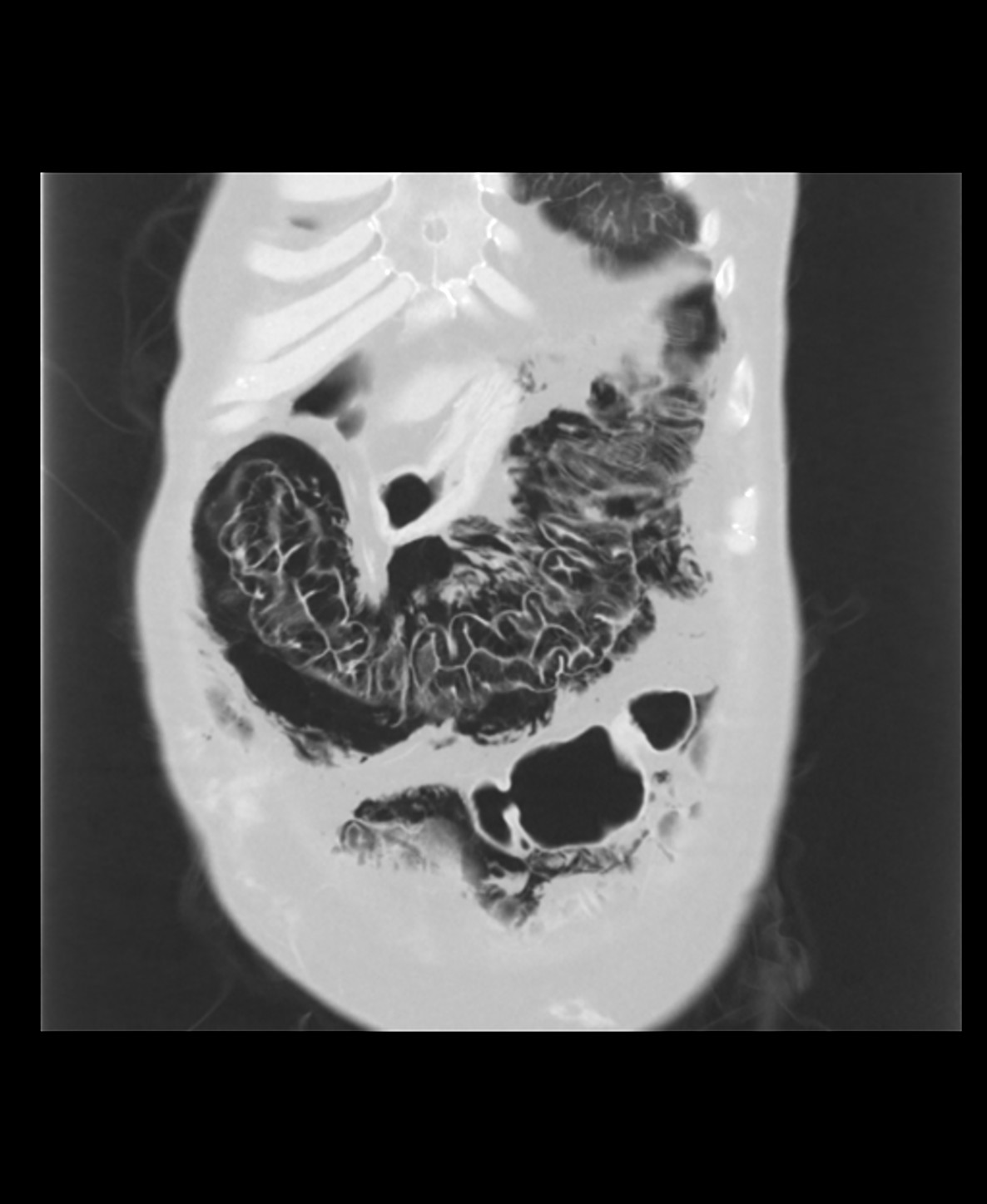 Pneumatosis Cystoides Intestinalis Image