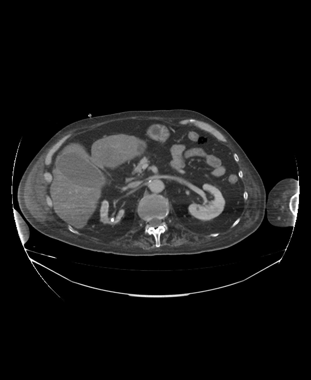 Pneumatosis cystoides intestinalis | Image | Radiopaedia.org