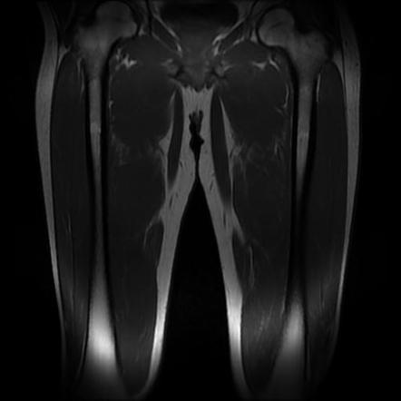 Rectus femoris muscle injury | Radiology Case | Radiopaedia.org