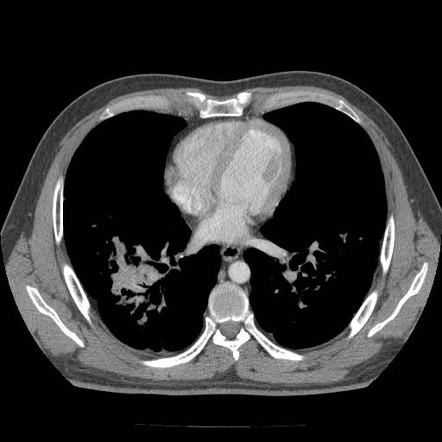 Silicosis (complicated with progressive massive fibrosis) | Image ...