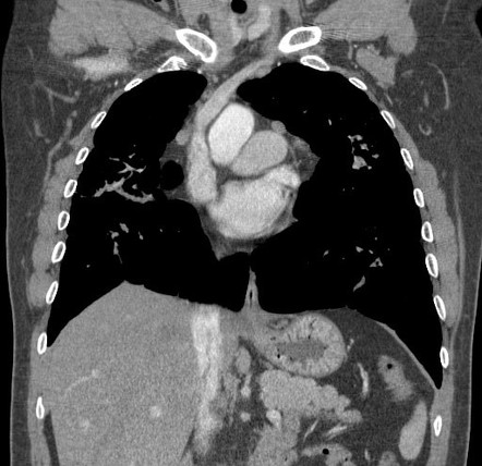 Silicosis (complicated with progressive massive fibrosis) | Image ...