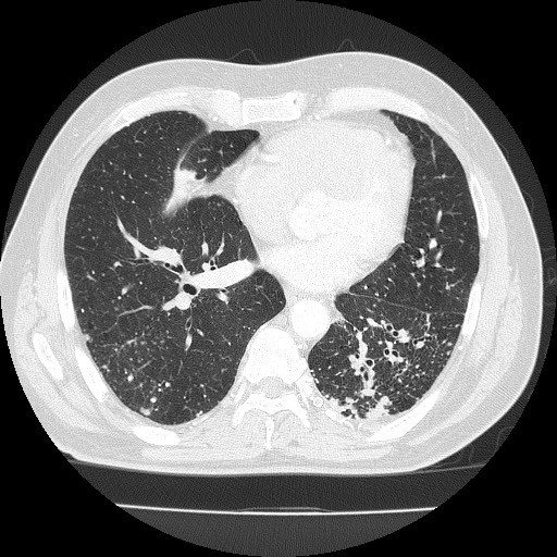 File:Silicosis, progressive massive fibrosis, and putty kidney ...